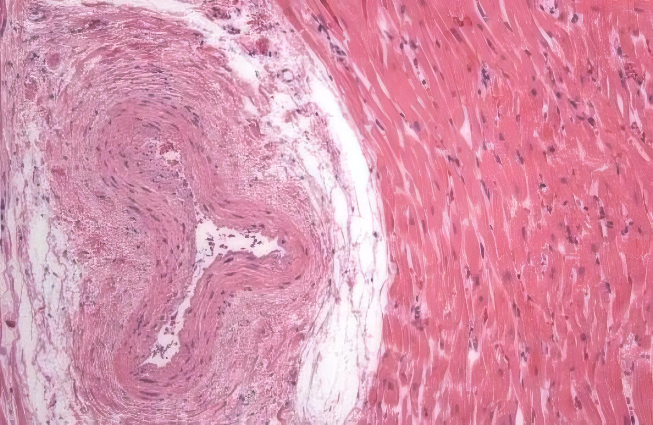 David Kirby - Coronary